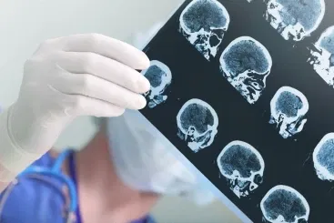 Stroke Injury