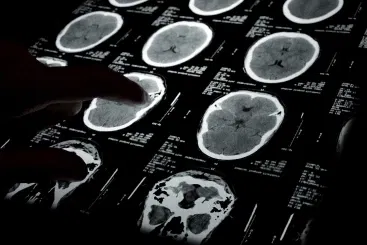 $29 Million Recovery In A Pediatric Brain Injury Case