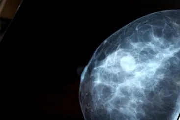 Failure to Diagnose Cancer