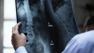 Doctor examining a spinal X-ray film held up to the light for personal injury or medical malpractice review