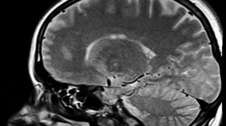 Sagittal MRI brain scan showing brain structure used as medical evidence in a personal injury lawsuit