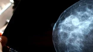 Mammogram imaging on a digital screen showing dense breast tissue for cancer misdiagnosis malpractice claim