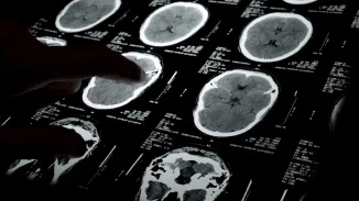 A finger pointing to one of several brain CT scan images displayed on a light board in a darkened room