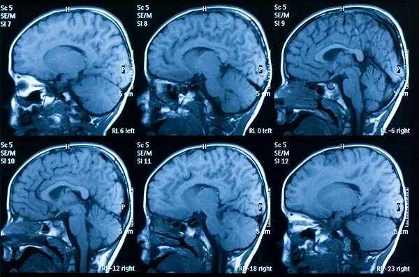 Brain MRI scan series showing multiple cross-sections representing traumatic brain injury in personal injury case