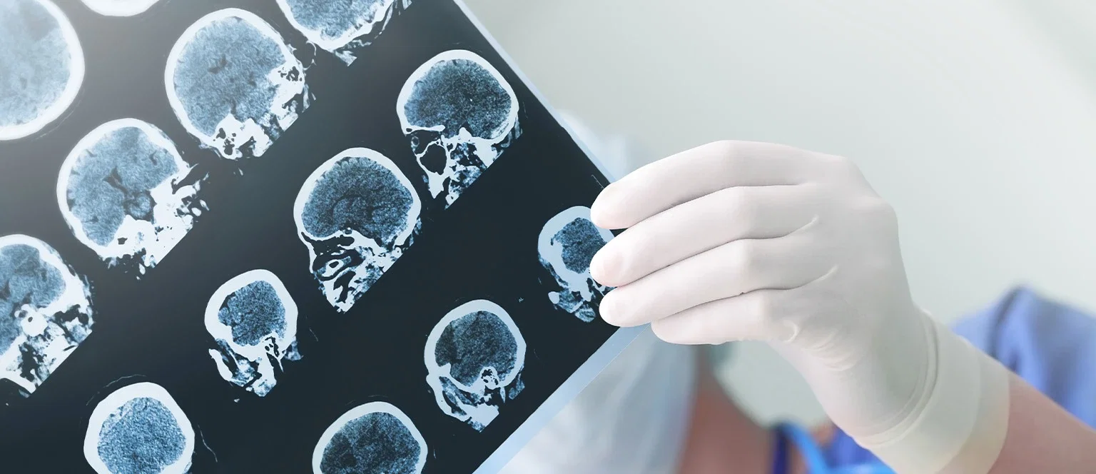 Medical professional in gloves examining brain CT scan images for traumatic brain injury litigation