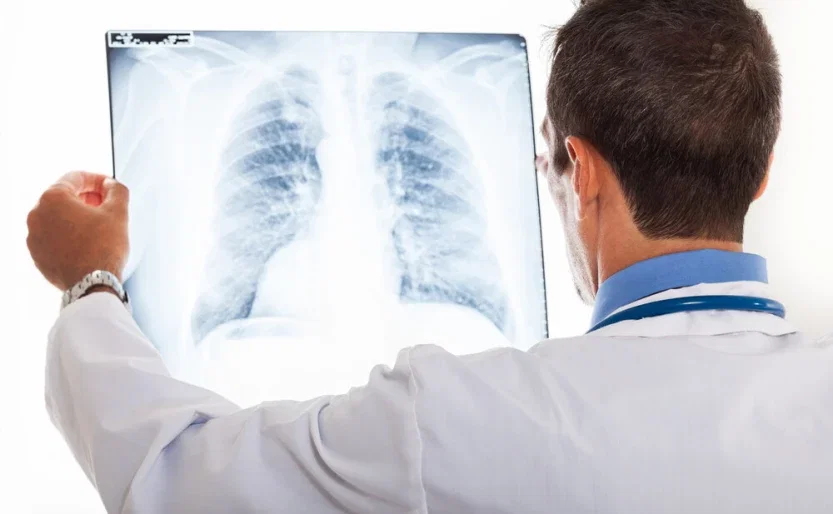 Doctor examining chest X-ray relevant to personal injury or medical malpractice claim evaluation